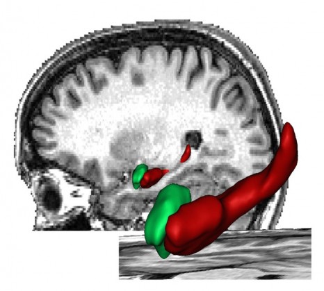 alzheimer_cerveau hippocampe15042010