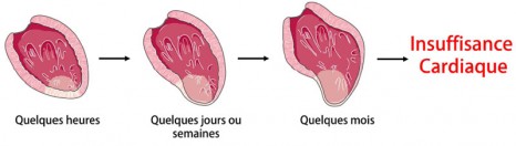fig1_pinet Coeur insuffisance cardiaque