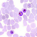 Plasmodium Falciparum globules rouges