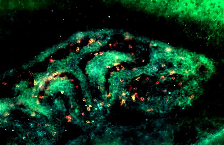 Marquage de lymphocytes T cytotoxiques (CD8 en rouge et le marqueur de "résidence" CD103 en vert) logés dans le plexus choroïde d’un cerveau infectée par le parasite Toxoplasma gondii.