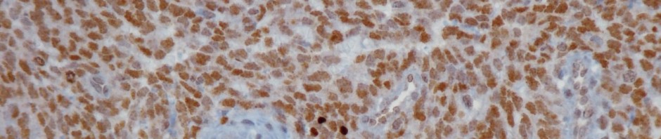 Discovery of a new type of bone sarcoma