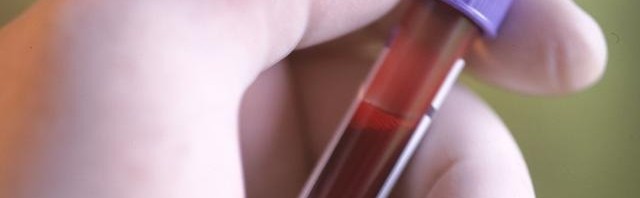(French) ADN tumoral circulant dans le sang : un nouveau biomarqueur du cancer