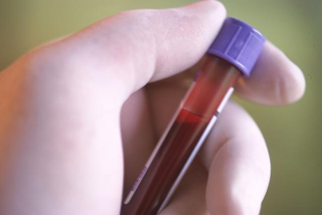 ADN tumoral circulant dans le sang : un nouveau biomarqueur du ...