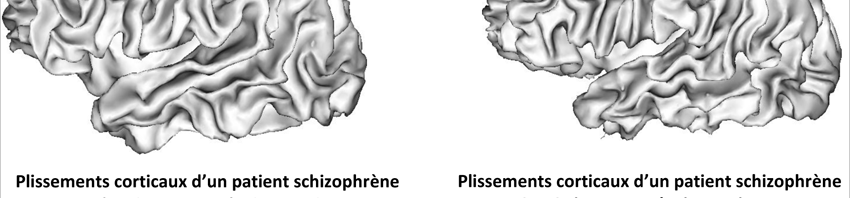 MRI scans reveal disrupted brain development in some schizophrenic patients