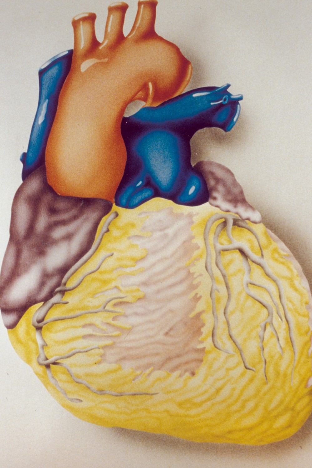 Essai Bonami : Résultats d’une nouvelle approche de thérapie cellulaire pour le cœur