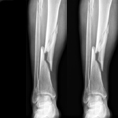 Regenerative medicine: clinical trials launched for the treatment of delayed union fractures