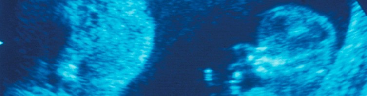 Autism and high pollution levels