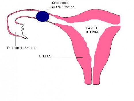 Schéma grossesse extra-utérine