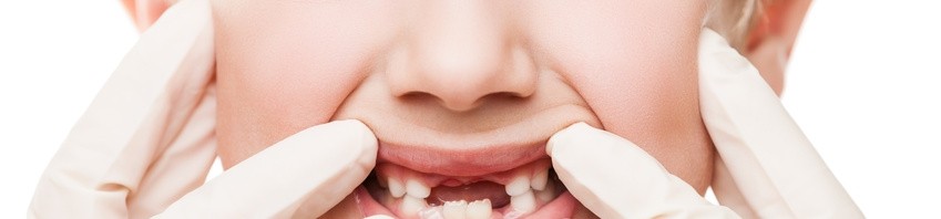 Une exposition précoce au bisphénol A altèrerait l’émail des dents