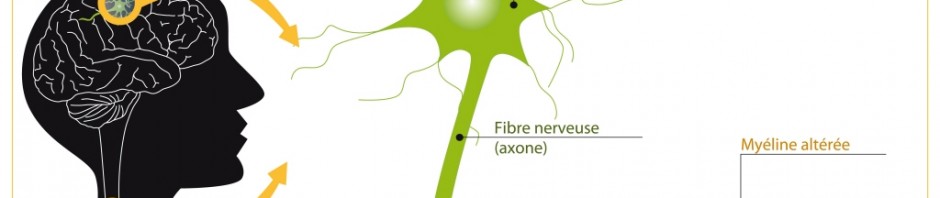 Sclérose en plaques : un composé thérapeutique pour réparer les fibres nerveuses endommagées