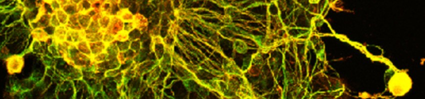 11 October: Huntington’s Disease Day in France