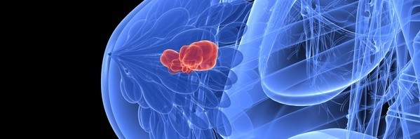 Cancers du sein – Découverte d’un marqueur du risque de métastases pulmonaires