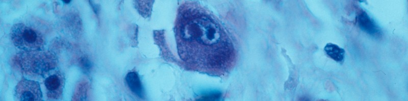 Vers un traitement de la lymphocytopénie T CD4 idiopathique