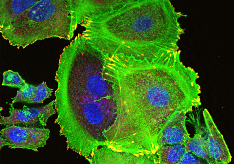 Photo d'imagerie en microscopie électronique montrant la transformation des cellules mammaires tumorales dans le cancer du sein