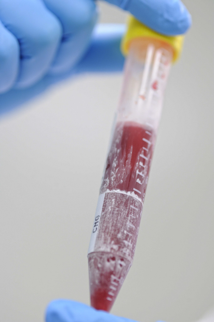 Coviplasm : tester l’efficacité de la transfusion de plasma de patients convalescents du Covid-19 dans le traitement de la maladie