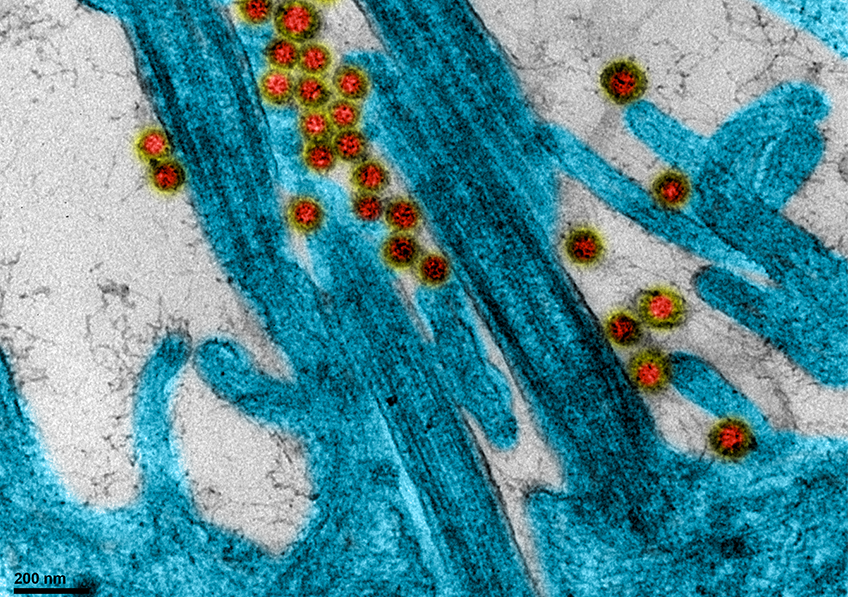 Coronavirus SARS-CoV-2 accrochés au niveau des cils de cellule épithéliale respiratoire humaine.
