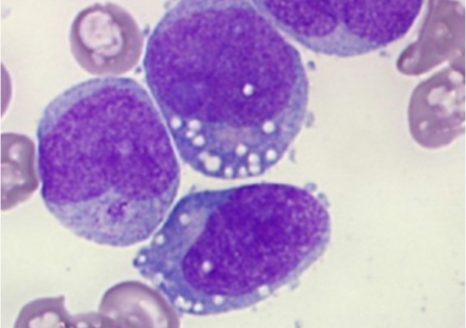 Cellules leucémiques