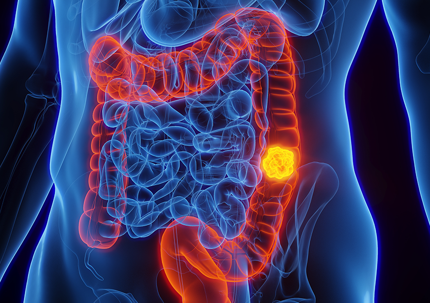 Illustration médicale en 3D de l'anatomie masculine - Cancer du côlon ; côlon descendant.