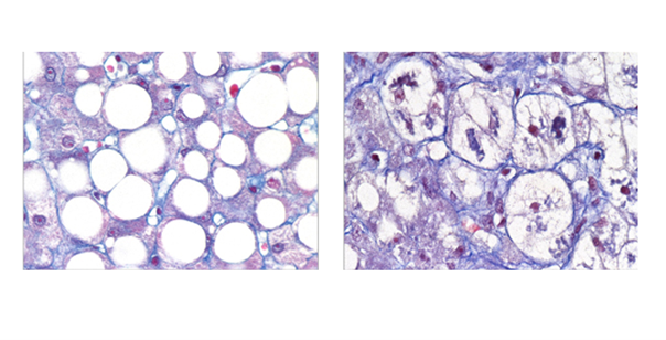 La MASH est une pandémie croissante dans le monde entier, qui va de pair avec l'augmentation de l'obésité et du diabète. Il s'agit également d'un domaine où les besoins médicaux non satisfaits sont importants. Crédits : François Pattou