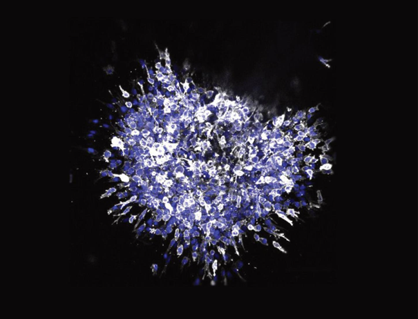 Cellules cancéreuses du sein, stimulée par la protéine SMYD2.