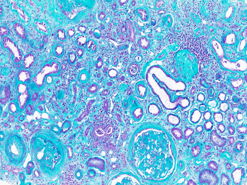 Découverte d’un nouveau mécanisme clé de la progression des maladies rénales