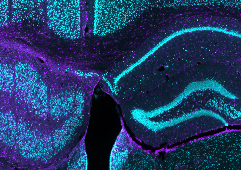 Épilepsie : une thérapie non invasive par rayons X représente un nouvel espoir pour les formes résistantes