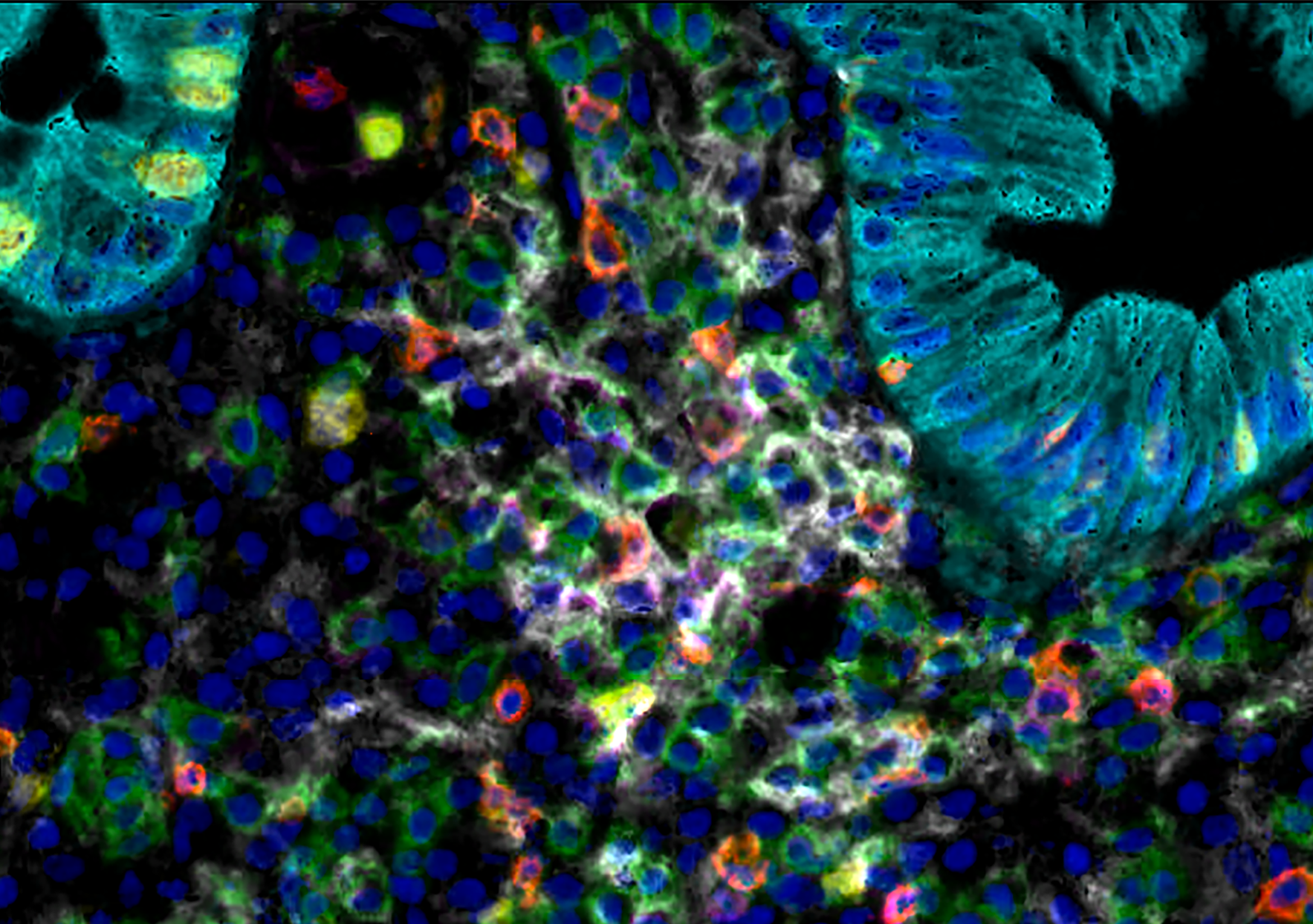From precancerous lesions to colorectal cancer: shedding light on unexpected biological mechanisms