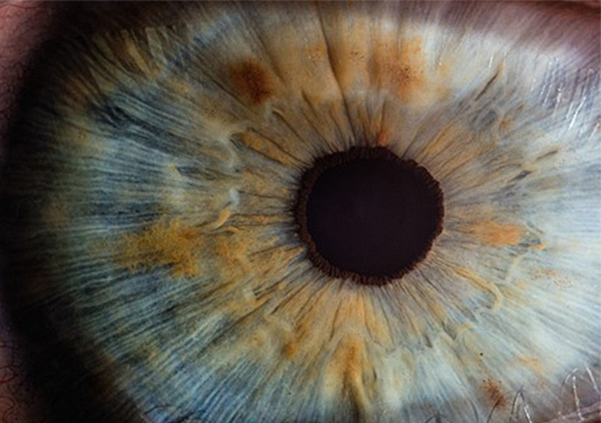 Un implant sous-rétinien restaure partiellement la vision de personnes atteintes de DMLA